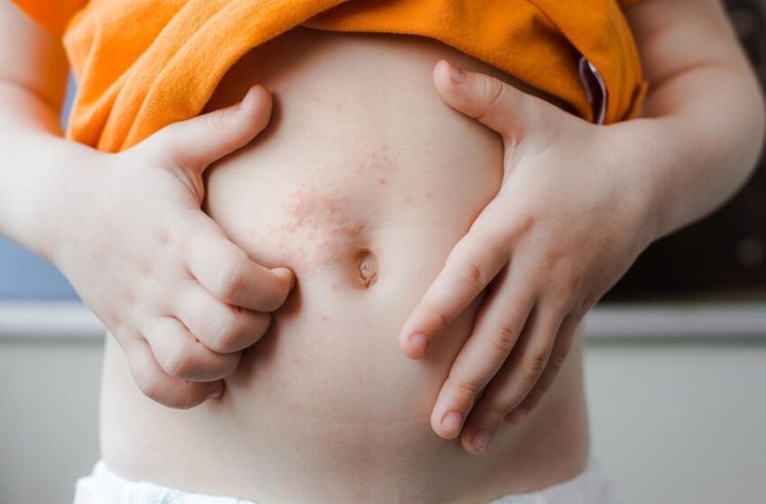  Los hijos con padres afectados por dermatitis atópica tienen un 80% de probabilidad de padecerla