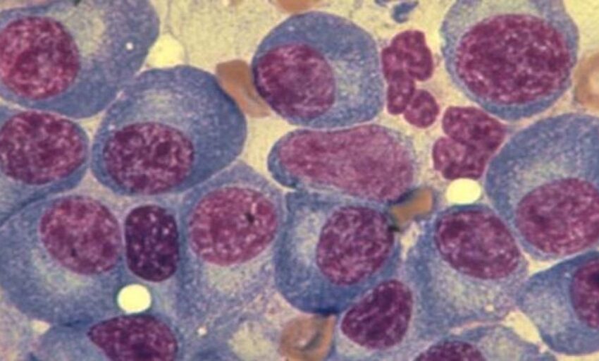  Esta nueva clase de fármacos ataca la leucemia mieloide aguda