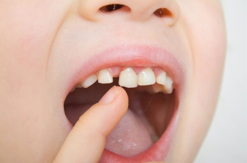  Los dientes de leche, como los anillos de un árbol: dan pistas sobre los niños que tendrán riesgo de trastorno mental