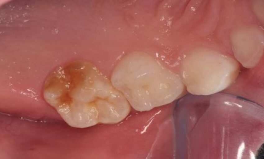  Resuelto el misterio del origen de las manchas blancas, amarillas y marrones en los dientes