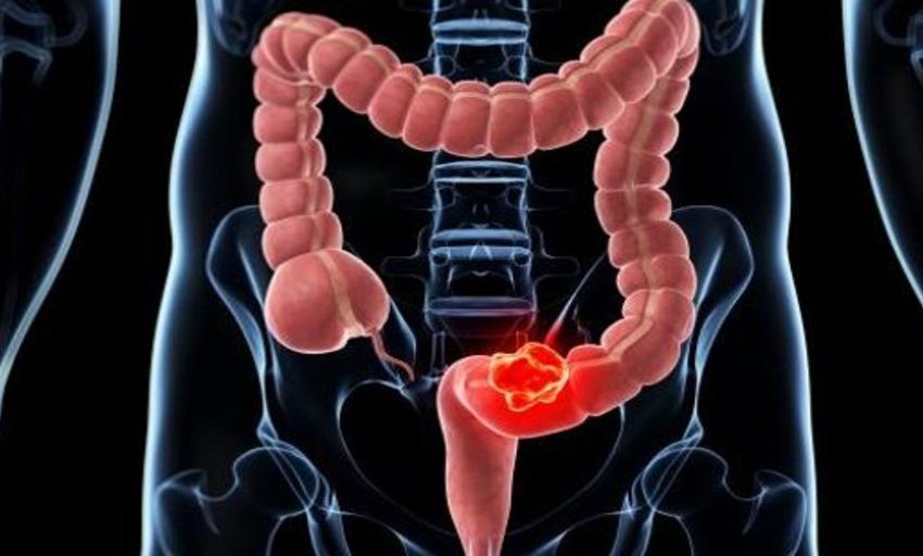  Cáncer de colon: Estos son los síntomas de alerta del tumor más diagnosticado en España