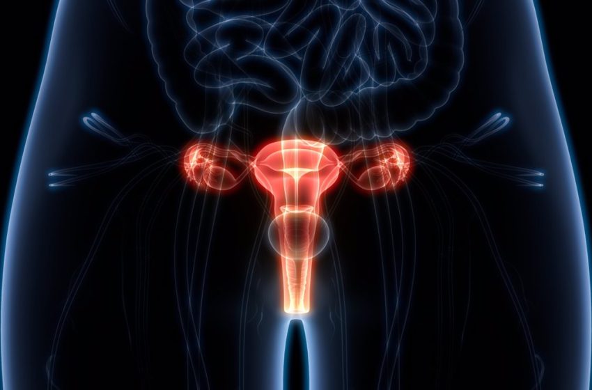  La endometriosis y el cáncer de ovario, ligadas genéticamente: esta es la conexión