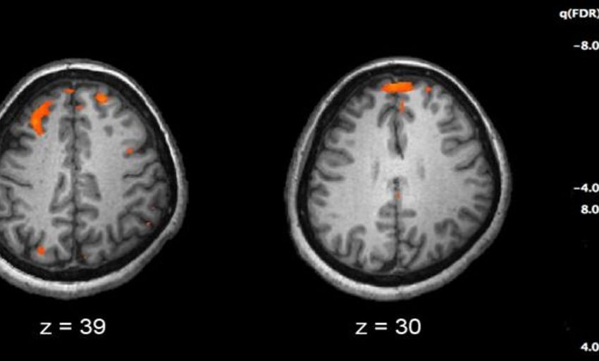  Un fallo en la comunicación de las neuronas causa la esquizofrenia