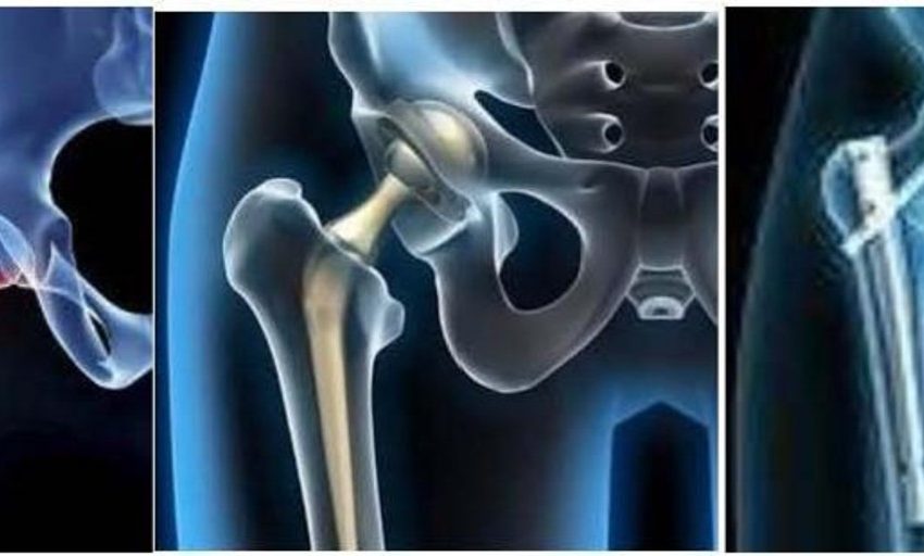  Por qué es tan importante la cirugía precoz en pacientes con fracturas de cadera