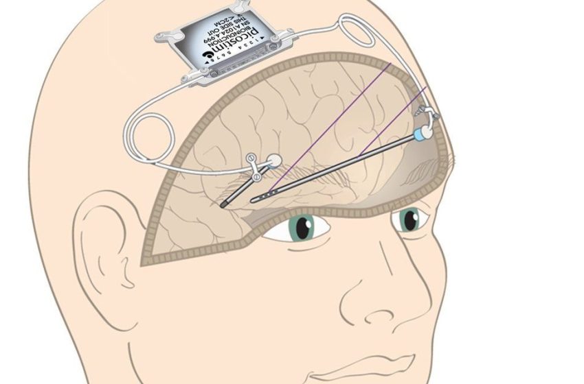  El implante cerebral que podría revertir los síntomas del Parkinson