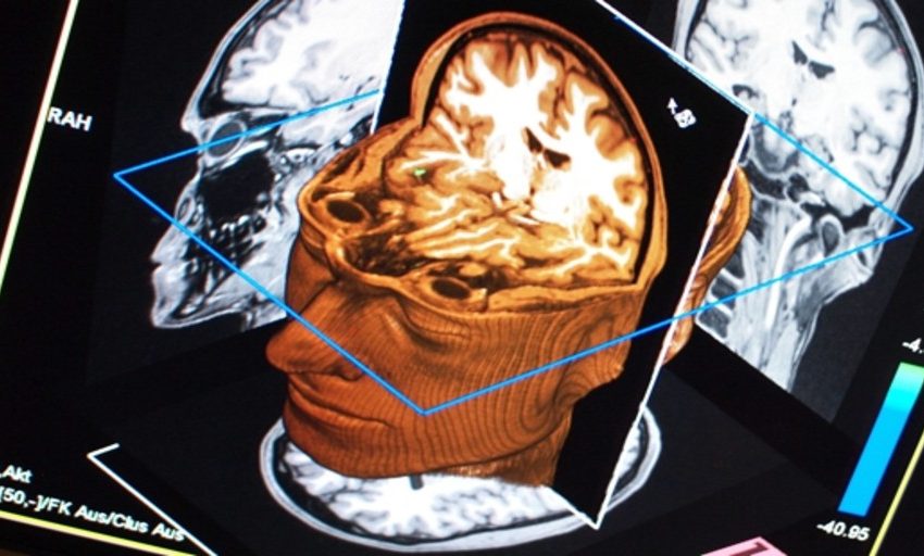  Un escáner puede diagnosticar el alzhéimer precoz con un 98% de fiabilidad