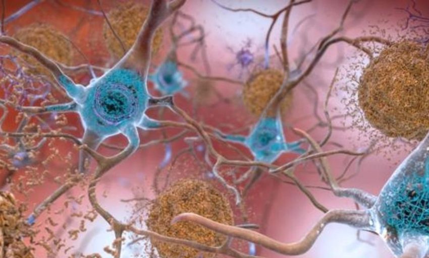  Un nuevo fármaco para el alzhéimer reduce el daño en el cerebro