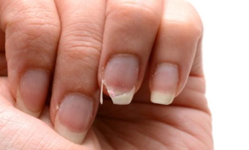  Lo que las uñas dicen sobre ti: la forma, color y marcas pueden revelar problemas de salud