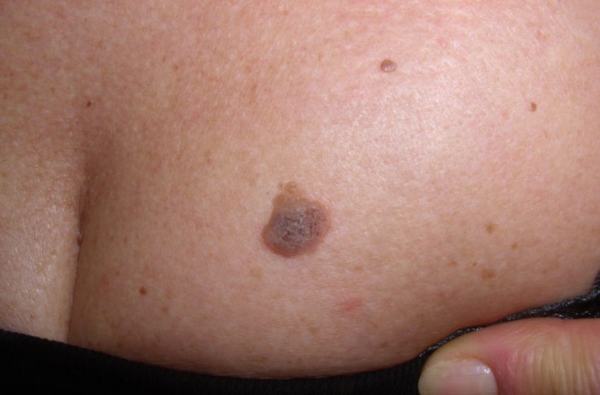  La inmunoterapia combinada logra éxito en el melanoma más agresivo