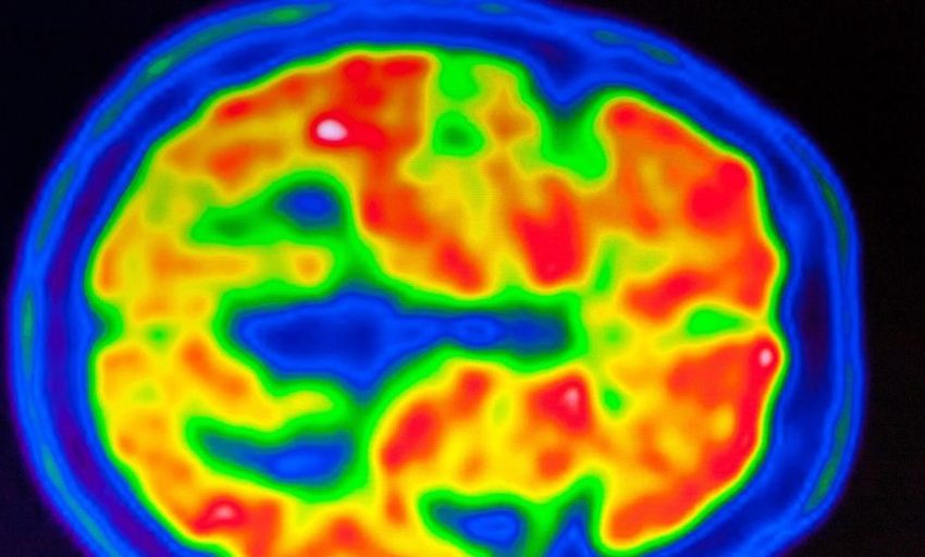  El nuevo fármaco para el alzhéimer también llega con polémica
