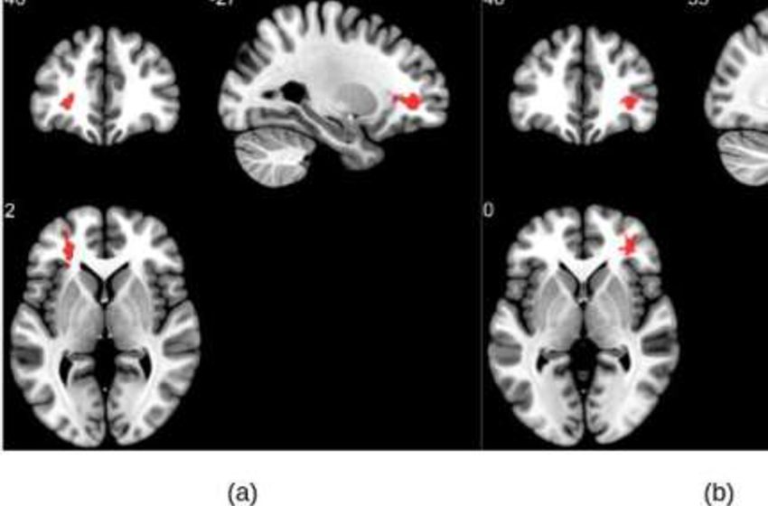  Las imágenes que muestran cómo afecta el Covid al cerebro