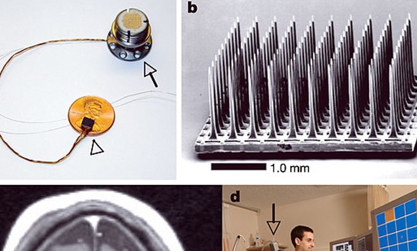  Un ensayo clínico confirma el potencial de los implantes de electrodos en ELA
