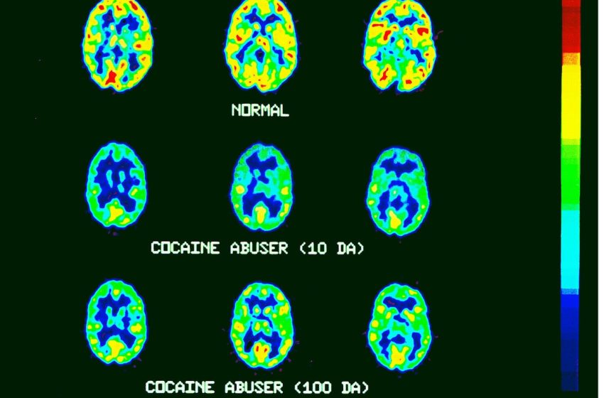  Así altera la cocaína los genes del cerebro
