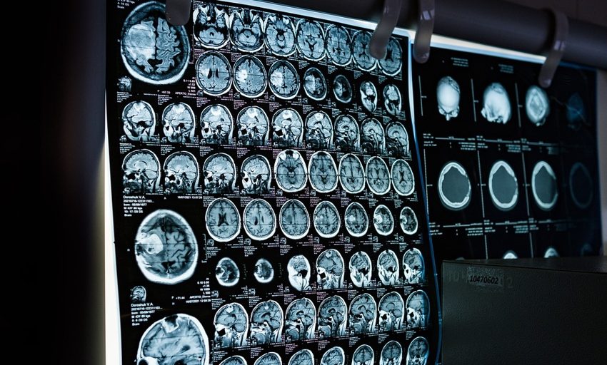  Científicos descubren un tratamiento que ralentiza la progresión de un tipo de cáncer cerebral incurable