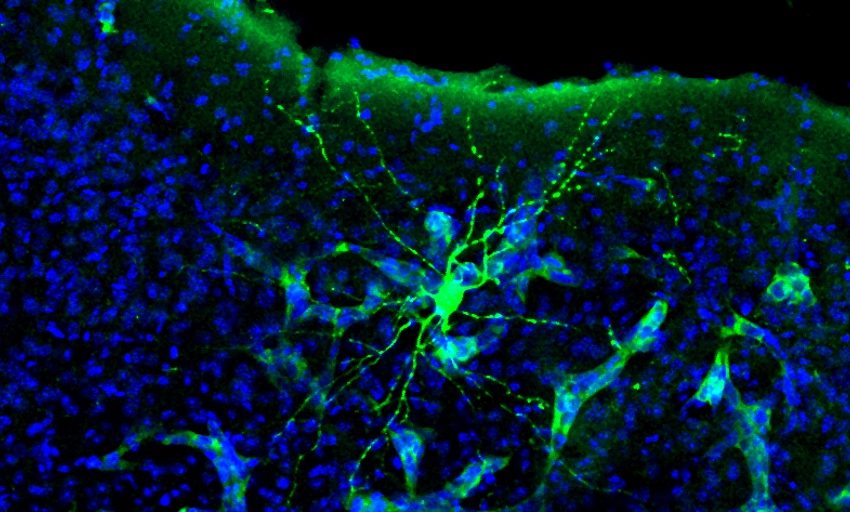  Los cánceres cerebrales ‘hackean’ las neuronas para causar deterioro cognitivo