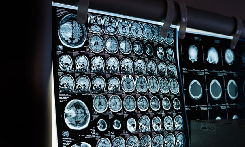  Por qué algunos cánceres cerebrales no responden a la inmunoterapia