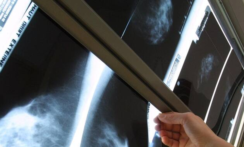  Haber tenido un falso positivo en un mamografía eleva el riesgo de cáncer de mama
