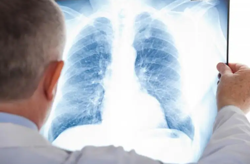  Esta proteína clave en propagar cáncer de pulmón ya puede controlarse