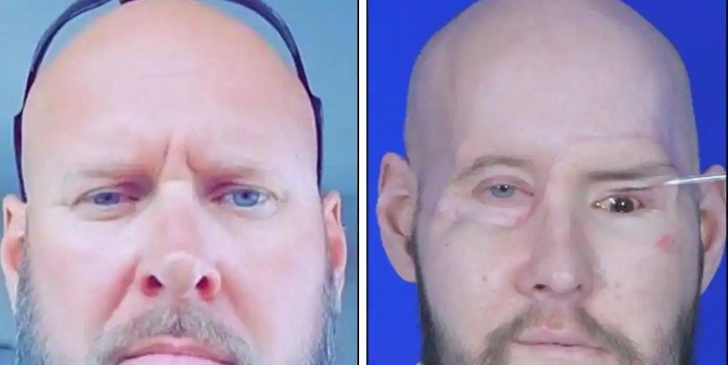 Primer trasplante completo de ojo y de cara parcial del mundo