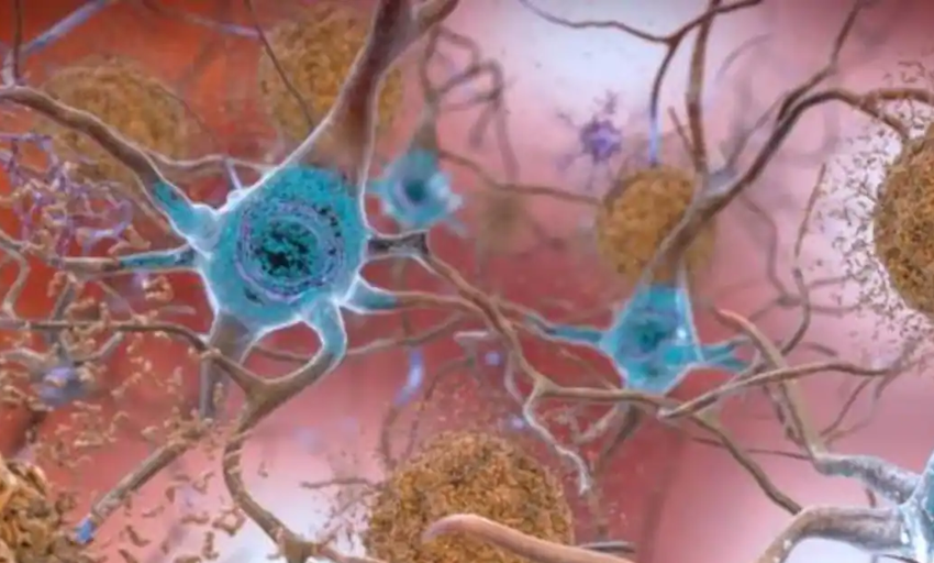  Esta proteína predice la progresión del alzhéimer en las personas mayores