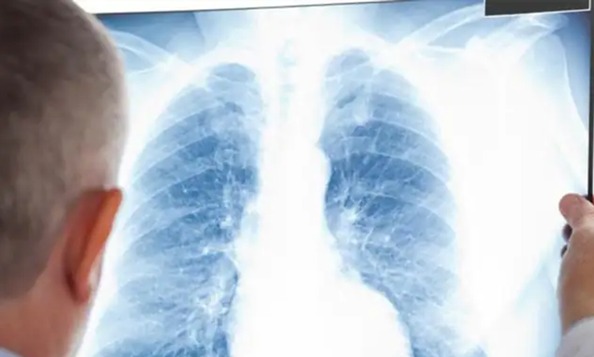  Aprobada en España la primera terapia dirigida para un tipo agresivo de cáncer de pulmón