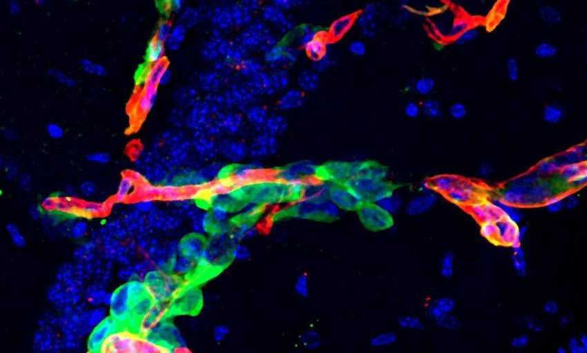  ¿Qué hace que unas células hagan metástasis en cáncer y otras no? Un estudio explica por qué