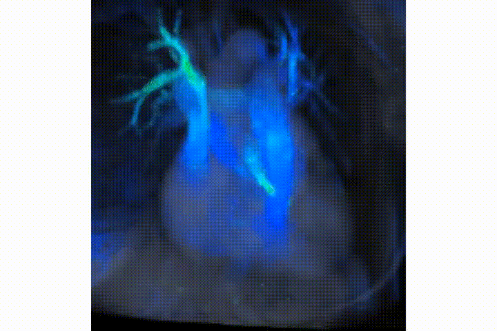  Ventajas del 4D FLOW: diagnósticos precisos gracias a la IA en las resonancias magnéticas del corazón
