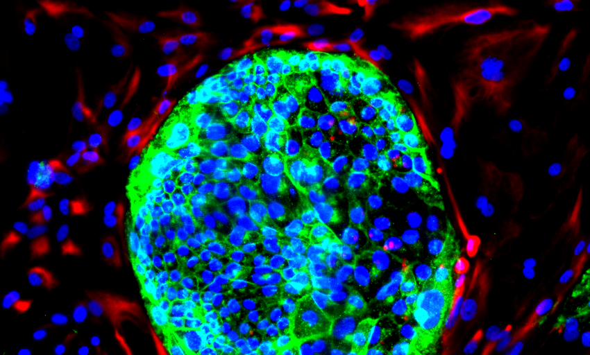  La terapia celular de nueva generación puede con un cáncer cerebral mortal