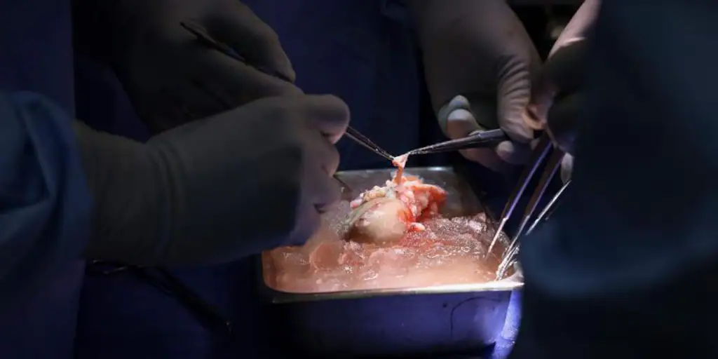  El primer paciente trasplantado con un riñón de cerdo recibe el alta